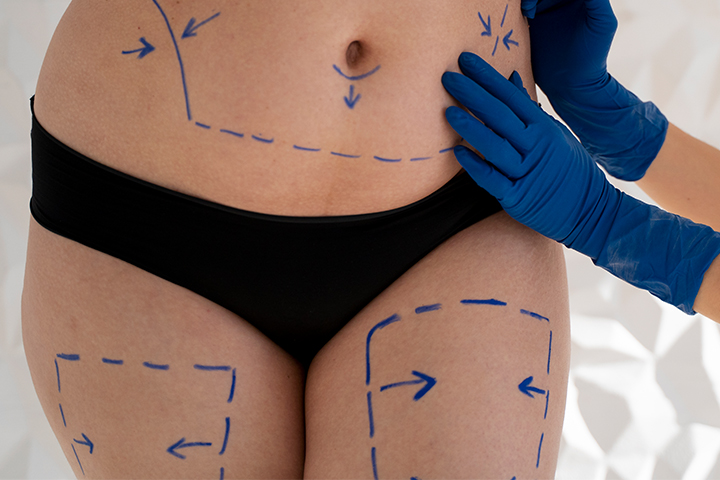 Body contouring