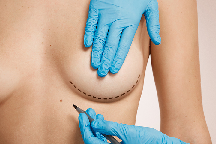 Breast surgery
