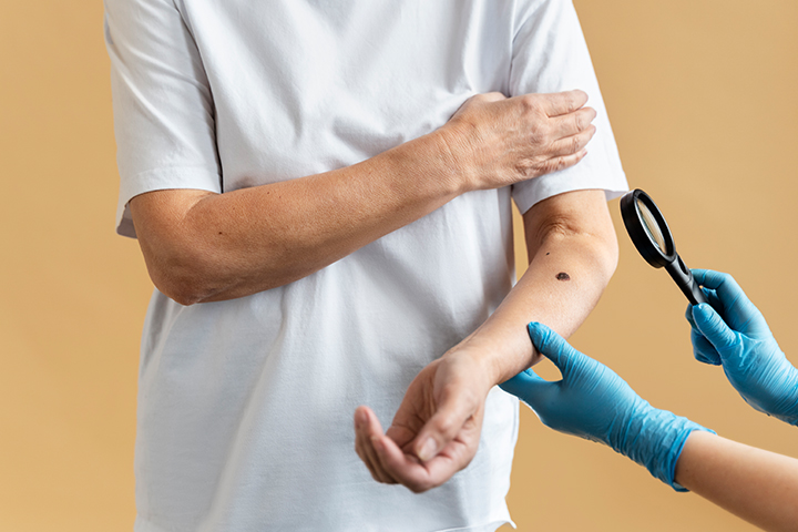 Skin lesion